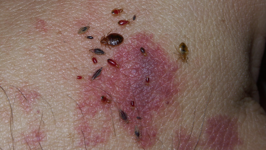 Punaises de lit : Est-ce que les punaises de lit transmettent des maladies ? Illustration scientifique, piqûres, zone cutanée, absence de symboles d’agents infectieux.